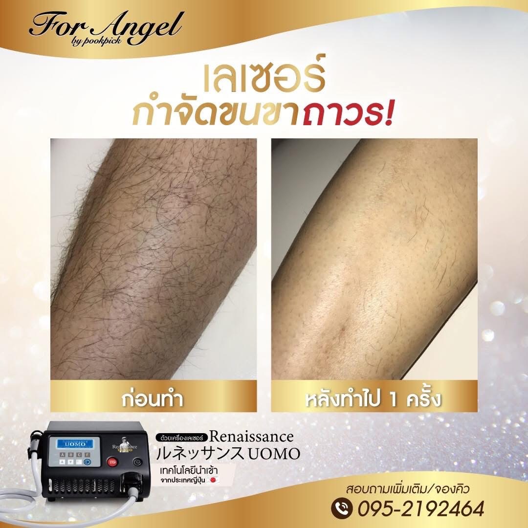 1 - https://พีแองเจิลคลินิก.com | P Angel Clinic ให้บริการเลเซอร์ติ่งเนื้อ กระเนื้อด้วย CO2 Laser ไม่ทิ้งรอยแผลเป็น 1 - https://พีแองเจิลคลินิก.com | P Angel Clinic ให้บริการเลเซอร์ติ่งเนื้อ กระเนื้อด้วย CO2 Laser ไม่ทิ้งรอยแผลเป็น