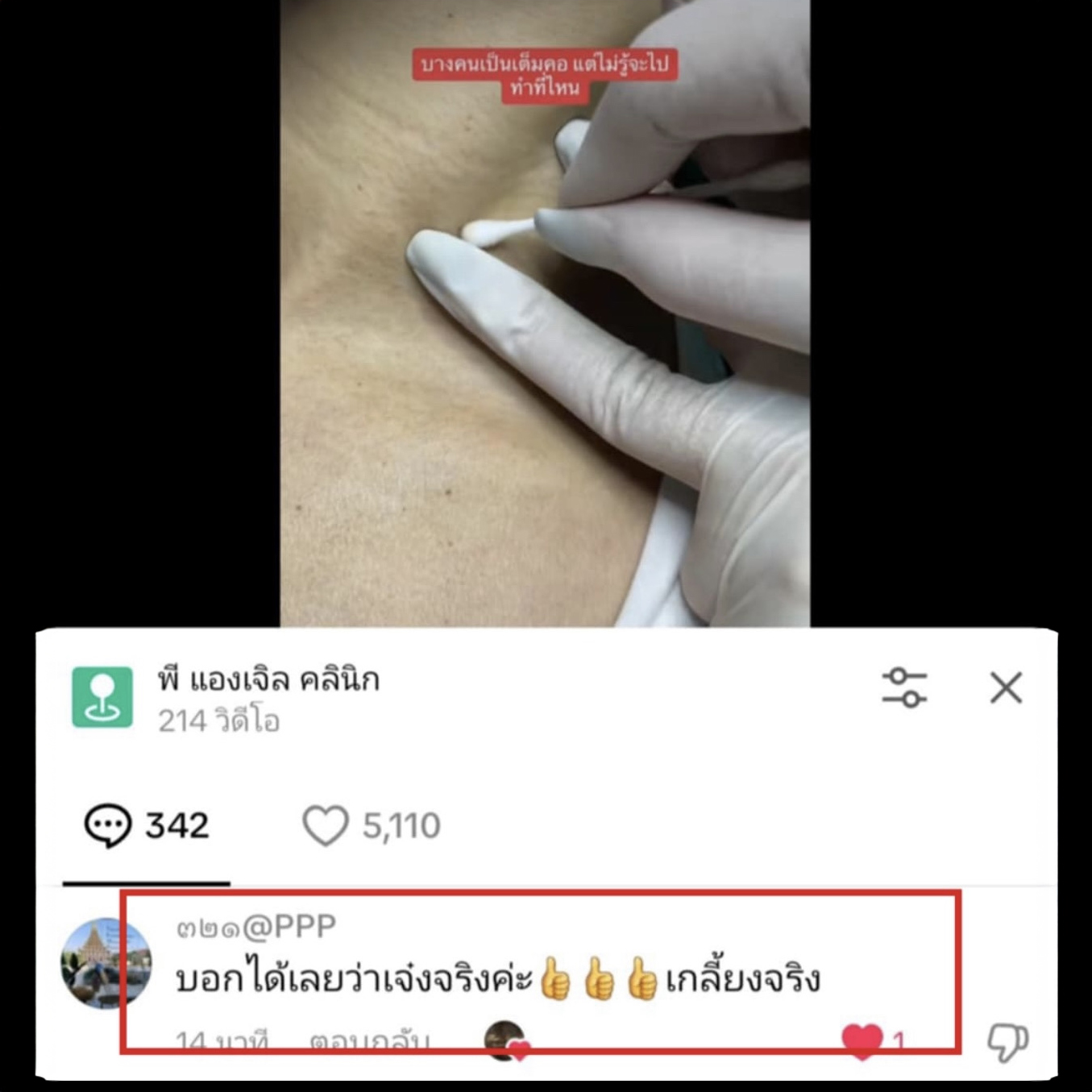 12 - https://พีแองเจิลคลินิก.com | P Angel Clinic ให้บริการเลเซอร์ติ่งเนื้อ กระเนื้อด้วย CO2 Laser ไม่ทิ้งรอยแผลเป็น 12 - https://พีแองเจิลคลินิก.com | P Angel Clinic ให้บริการเลเซอร์ติ่งเนื้อ กระเนื้อด้วย CO2 Laser ไม่ทิ้งรอยแผลเป็น