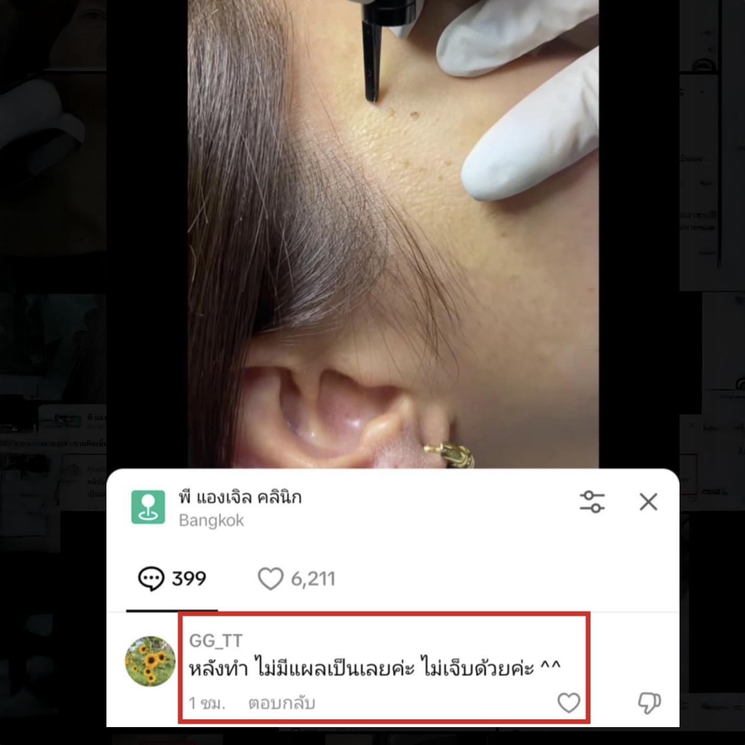 13 - https://พีแองเจิลคลินิก.com | P Angel Clinic ให้บริการเลเซอร์ติ่งเนื้อ กระเนื้อด้วย CO2 Laser ไม่ทิ้งรอยแผลเป็น 13 - https://พีแองเจิลคลินิก.com | P Angel Clinic ให้บริการเลเซอร์ติ่งเนื้อ กระเนื้อด้วย CO2 Laser ไม่ทิ้งรอยแผลเป็น