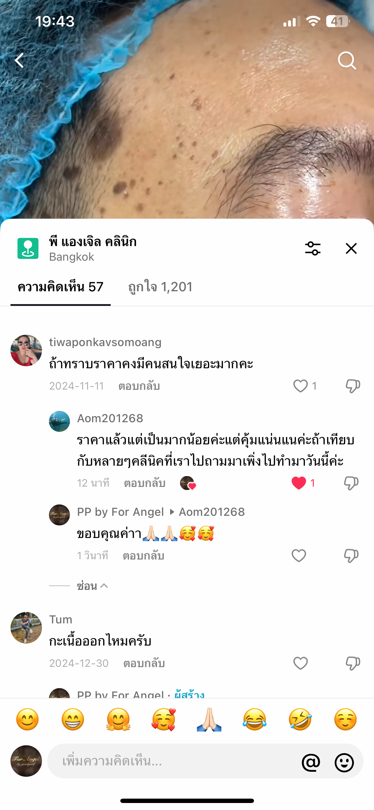 16 - https://พีแองเจิลคลินิก.com | P Angel Clinic ให้บริการเลเซอร์ติ่งเนื้อ กระเนื้อด้วย CO2 Laser ไม่ทิ้งรอยแผลเป็น 16 - https://พีแองเจิลคลินิก.com | P Angel Clinic ให้บริการเลเซอร์ติ่งเนื้อ กระเนื้อด้วย CO2 Laser ไม่ทิ้งรอยแผลเป็น