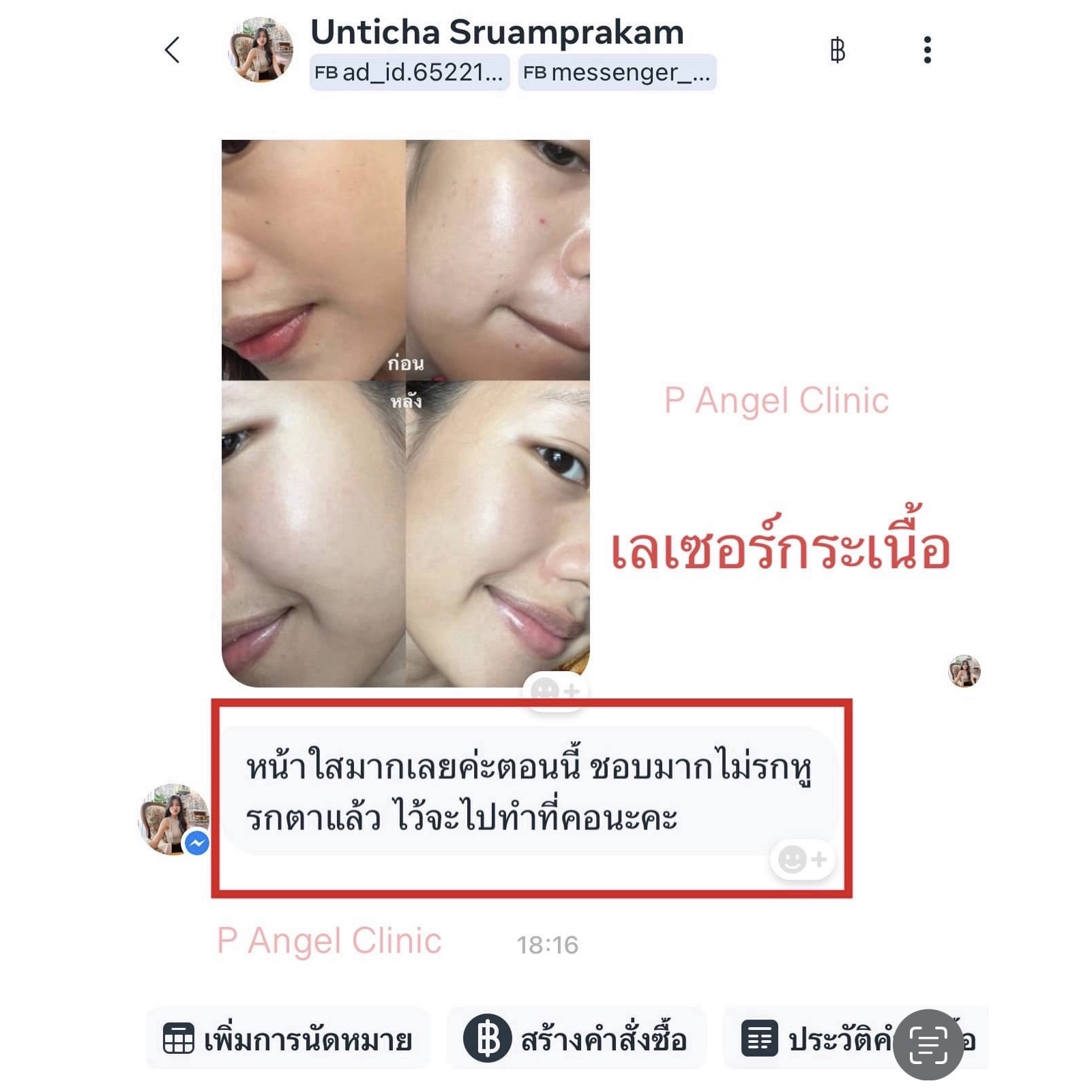 P Angel Clinic ให้บริการเลเซอร์ติ่งเนื้อ กระเนื้อด้วย CO2 Laser ไม่ทิ้งรอยแผลเป็น