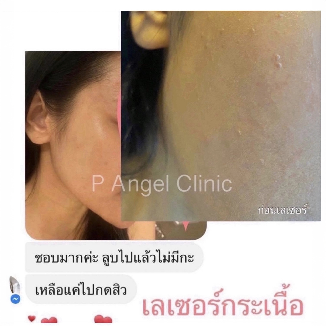 P Angel Clinic ให้บริการเลเซอร์ติ่งเนื้อ กระเนื้อด้วย CO2 Laser ไม่ทิ้งรอยแผลเป็น
