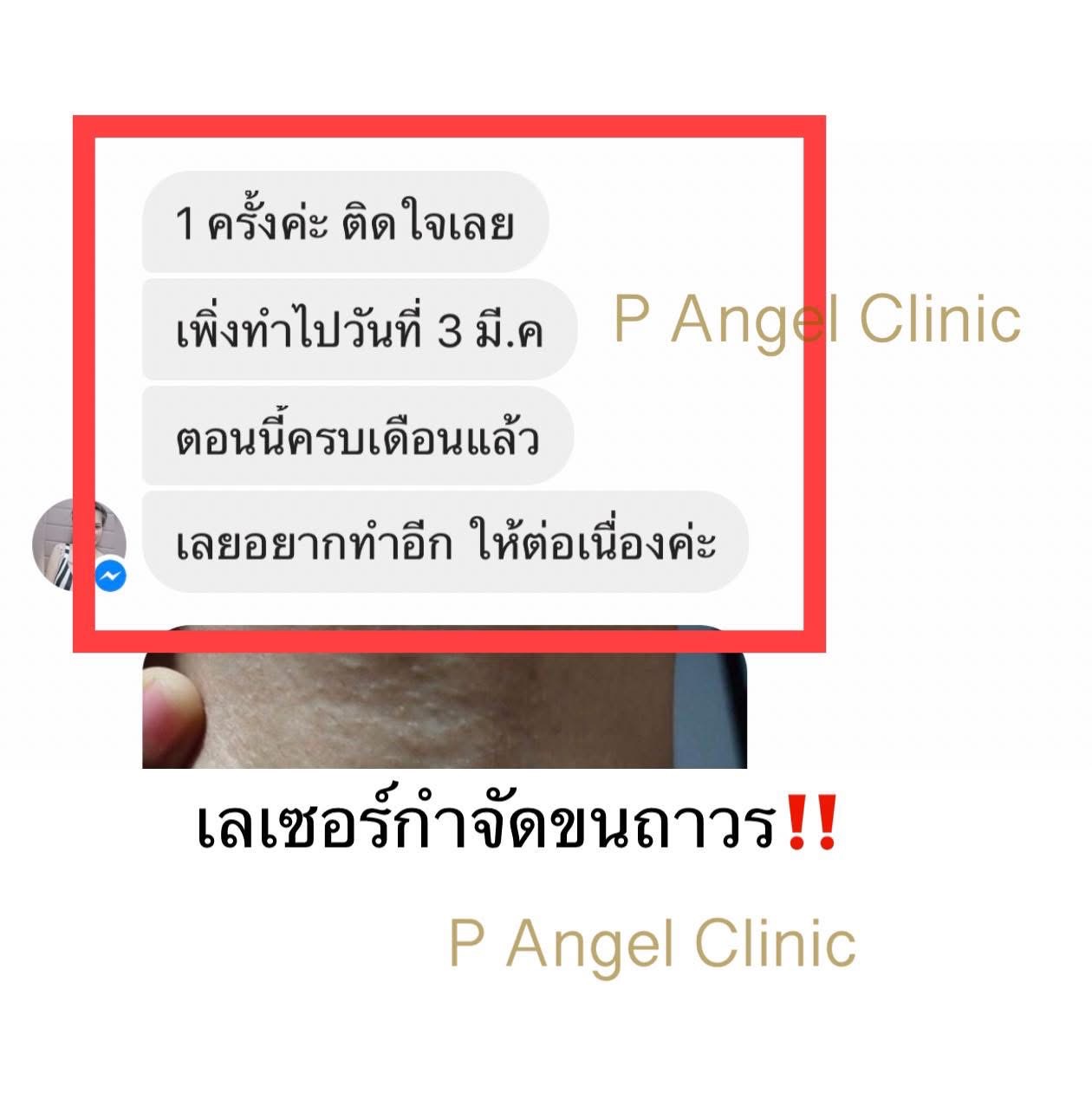 P Angel Clinic ให้บริการเลเซอร์ติ่งเนื้อ กระเนื้อด้วย CO2 Laser ไม่ทิ้งรอยแผลเป็น