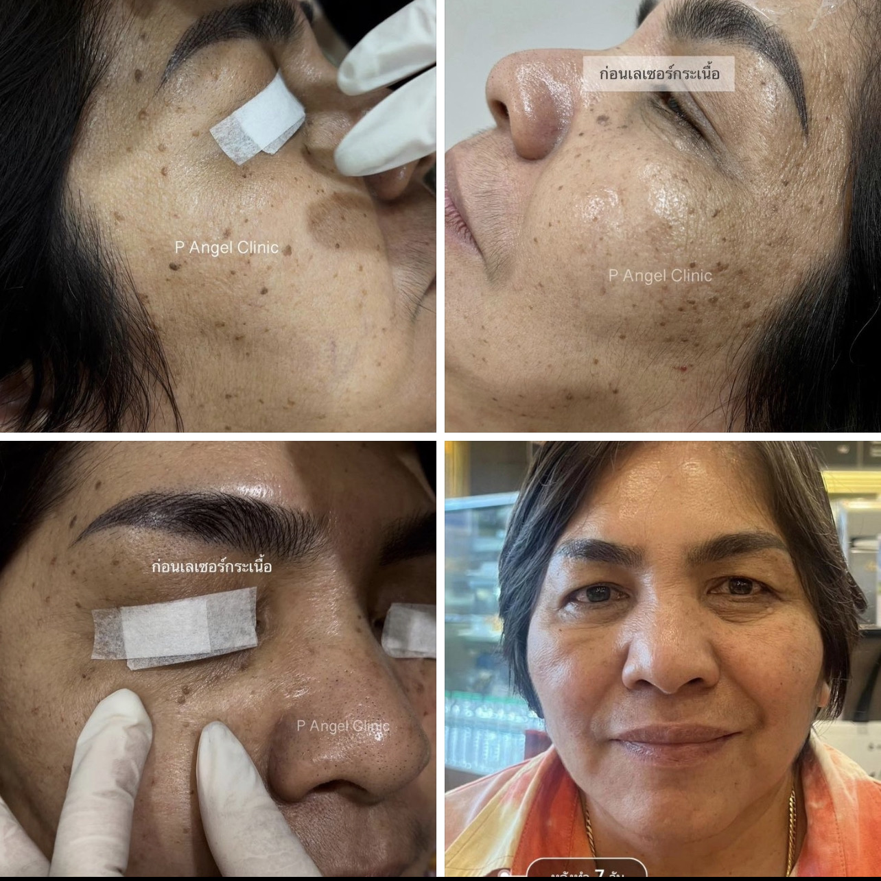 P Angel Clinic ให้บริการเลเซอร์ติ่งเนื้อ กระเนื้อด้วย CO2 Laser ไม่ทิ้งรอยแผลเป็น