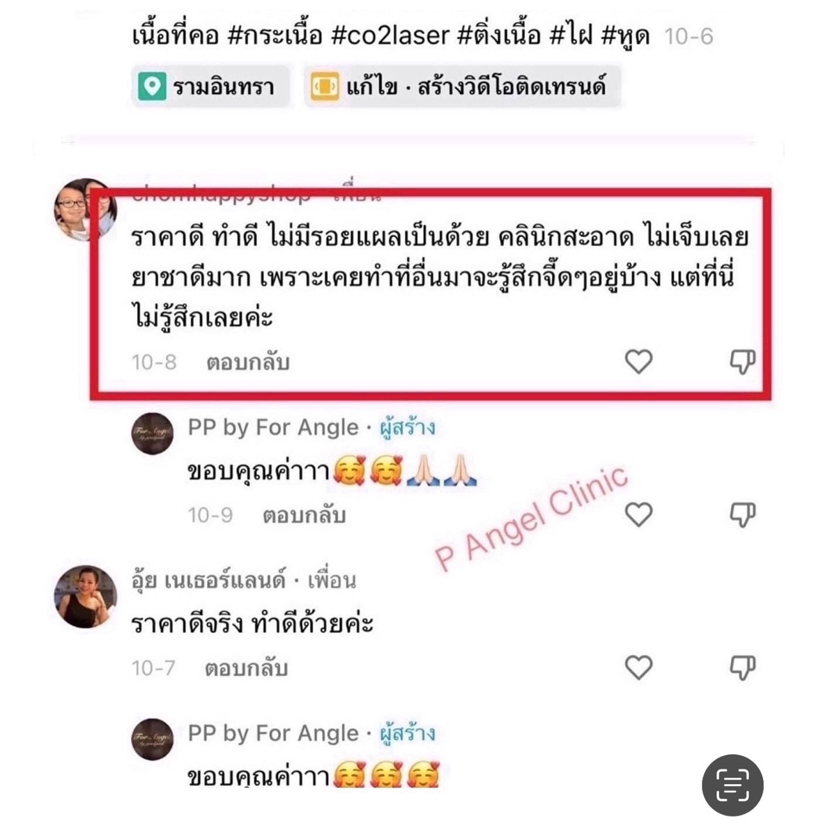 P Angel Clinic ให้บริการเลเซอร์ติ่งเนื้อ กระเนื้อด้วย CO2 Laser ไม่ทิ้งรอยแผลเป็น