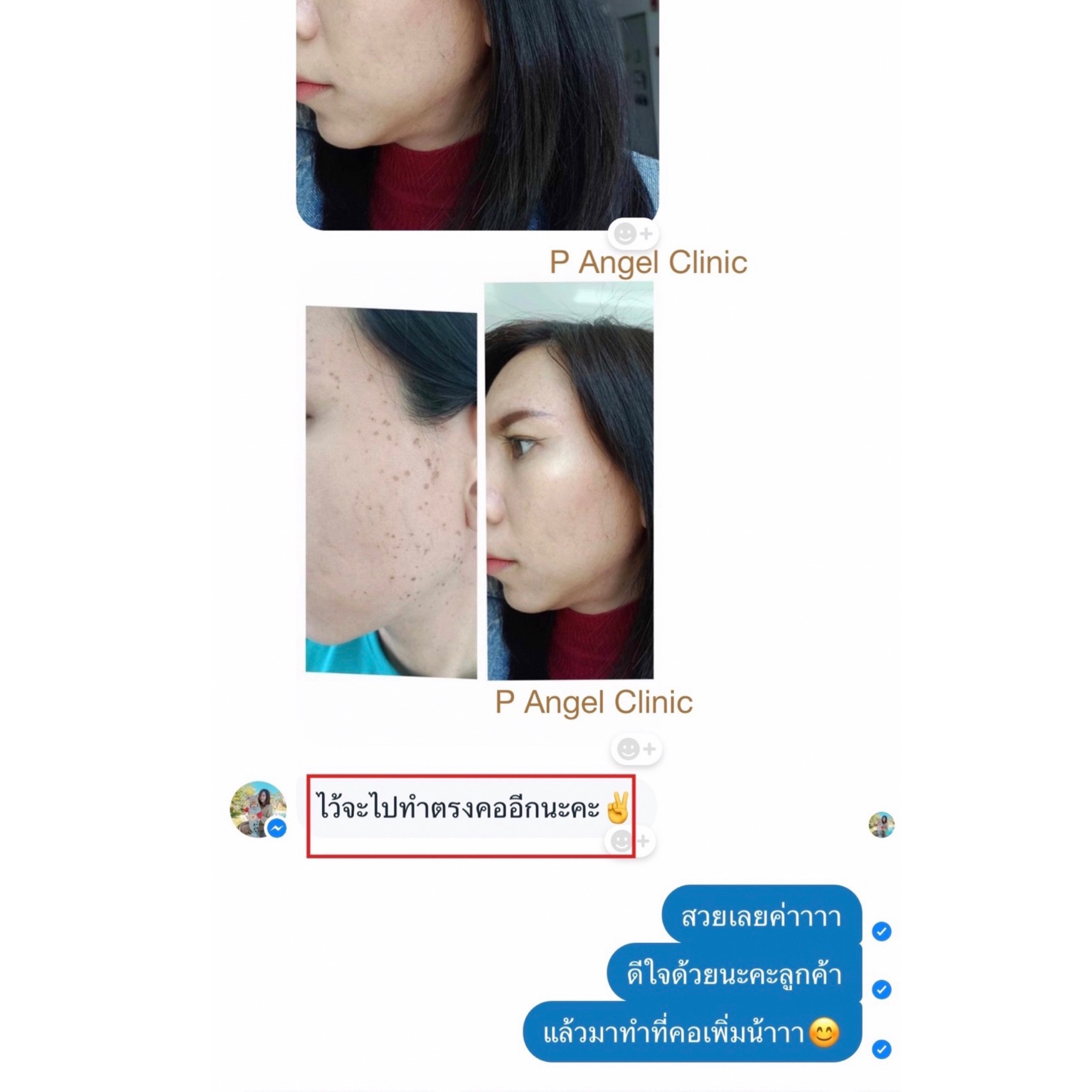 P Angel Clinic ให้บริการเลเซอร์ติ่งเนื้อ กระเนื้อด้วย CO2 Laser ไม่ทิ้งรอยแผลเป็น